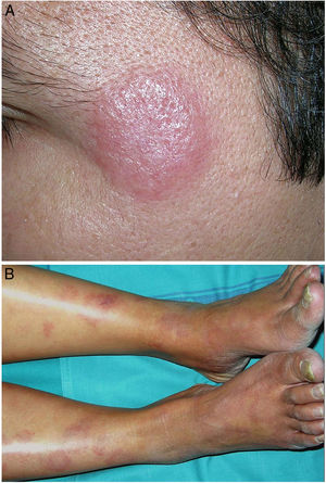 Lepra. A)Placa de lepra tuberculoide, eritematosa y bien delimitada, en la sien izquierda de un varón paraguayo joven. B)Lepra dimorfa. Máculas eritematosas diseminadas, alguna anular, por las piernas de una mujer filipina de edad media con lepra dimorfa.