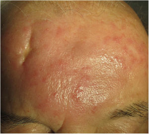 Enfermedad de Morbihan. Lesión eritemato-edematosa frontal.