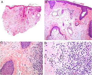 Enfermedad de Morbihan. A)Imagen panorámica en la que se observa edema dérmico con infiltrado inflamatorio perifolicular e intersticial (H&E ×20). B)Detalle del edema dérmico marcado junto con dilataciones vasculares (H&E ×100). C)Infiltrados linfohistiocitarios perivasculares (H&E ×200). D)Detalle de algunos polimorfonucleares neutrófilos en el infiltrado (H&E ×400).