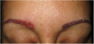 Sarcoidosis. Pápulas eritematosas en ambas cejas tras tatuaje cosmético (Cortesía Dr. J.F. Mir-Bonafé).