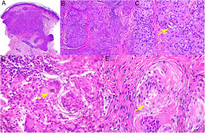 Sarcoidosis cutánea. A)Granulomas epitelioides que ocupan dermis superficial y media con escasos linfocitos en periferia (H&E ×20). B)Granulomas epitelioides compuestos por células con abundante citoplasma eosinófilo (H&E ×100). C)Partícula de sílice (flecha) en un granuloma sarcoideo (H&E ×200). D)Cuerpo de Schaumann (flecha) (H&E ×400). E)Cuerpo asteroide (H&E ×2.400).