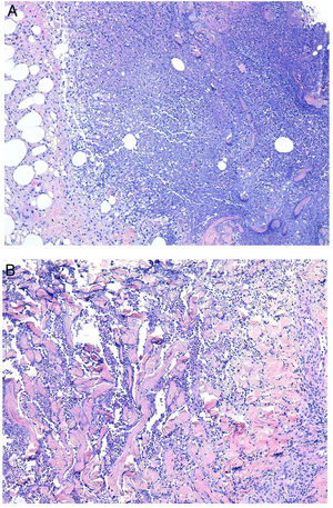 A)Dermatitis granulomatosa intersticial. Histiocitos dispuestos en empalizada en torno al área de necrosis con neutrófilos (H&E ×100). B)Dermatitis granulomatosa intersticial. Detalle de neutrófilos disecando colágeno con degeneración (H&E ×100).