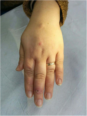 Patrón esporotricoide. Distribución de las lesiones a lo largo de un trayecto linfático (Cortesía del Dr. Fernando Cabo, Servicio de Dermatología, Hospital Universitario de Ourense, España).