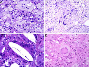 A) Células xantomatosas. Se trata de histiocitos con un alto contenido citoplásmico lipídico, lo que les confiere un aspecto multivesicular (H&E ×400). B) Células de Langhans. Muestran múltiples núcleos polarizados a un extremo de la célula con una distribución en «herradura» (H&E ×400). C) Células gigantes de tipo cuerpo extraño. Dos de ellas aparecen abrazando un espacio acicular vacío correspondiente a un cristal de colesterol. Ambas muestran muchos núcleos en disposición desordenada (H&E ×400). D) Célula gigante de tipo Touton. Muestra los núcleos distribuidos en un círculo. El citoplasma interior a los círculos es densamente eosinofílico, mientras que la franja externa presenta un aspecto xantomatoso (H&E ×400).