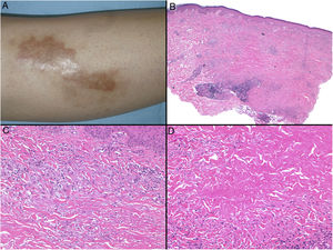 Necrobiosis lipoidea. A) Placa infiltrada de tonalidad eritemato-amarillenta y aspecto céreo, localizada en región pretibial. El centro de la placa, más claro, tiene un aspecto atrófico. B) En la visión panorámica se aprecia un infiltrado inflamatorio focal que parece dispuesto en capas más o menos paralelas a la epidermis, así como áreas de engrosamiento del colágeno, que se muestra intensamente eosinófilo. En la parte inferior de la biopsia, en dermis profunda, se observan agregados linfoides de distribución perianexial (H&E ×40). C) A mayores aumentos se observa un infiltrado inflamatorio granulomatoso intersticial, dispuesto entre haces de colágeno engrosado y necrobiótico. Pueden verse algunos histiocitos multinucleados (H&E ×200). D) En otra zona de la biopsia, a grandes aumentos, observamos un granuloma de disposición en empalizada, centrado por un área de marcada necrobiosis del colágeno (H&E ×400).