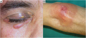 Clínica del xantogranuloma necrobiótico: A) Ejemplo de la presentación clínica más frecuente como pápulas y placas eritemato-amarillentas, afectando párpados. B) Localización extracutánea en forma de una placa ulcerada de coloración amarillento-anaranjada.