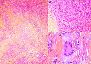 Histología del xantogranuloma necrobiótico. A) Infiltrado granulomatoso rodeando una zona central de necrobiosis eosinofílica con cristales de colesterol asociados (H&E ×40). B) El infiltrado histiocitario se acompaña de nódulos linfoides y células plasmáticas (H&E ×100). C) Detalle de una célula de Touton (H&E ×400).