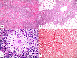 Piel laxa granulomatosa. A) Infiltración linfoide en dermis con numerosas células gigantes multinucleadas salpicadas (H&E ×40). B) Infiltración linfoide en septos de la hipodermis con células gigantes multinucleadas (H&E ×40). C) Detalle de una célula gigante con linfofagocitosis (H&E ×200). D) Fragmentación y pérdida de fibras elásticas (orceína ×100).