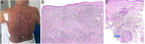 A) Micosis fungoide granulomatosa: Afectación extensa de la espalda por micosis fungoide (histopatológicamente granulomatosa) en una paciente de 77 años con lesiones diseminadas de larga evolución, mostrando placas y nódulos tumorales focalmente ulcerados (foto cortesía del Dr. César Pérez-Vega). B) Micosis fungoide granulomatosa: Además de afectación de la epidermis por linfocitos atípicos, infiltración transmural de la dermis que incluye células gigantes y granulomas de variable textura (H&E ×20). C) Linfoma T no micosis fungoides. Infiltración dérmica intersticial por linfoma T periférico con formación de un nódulo dérmico profundo en el que se localizan granulomas epitelioides confluyentes de tipo sarcoideo (flecha) con relación a células del linfoma (H&E ×10).