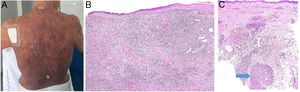 A) Micosis fungoide granulomatosa: Afectación extensa de la espalda por micosis fungoide (histopatológicamente granulomatosa) en una paciente de 77 años con lesiones diseminadas de larga evolución, mostrando placas y nódulos tumorales focalmente ulcerados (foto cortesía del Dr. César Pérez-Vega). B) Micosis fungoide granulomatosa: Además de afectación de la epidermis por linfocitos atípicos, infiltración transmural de la dermis que incluye células gigantes y granulomas de variable textura (H&E ×20). C) Linfoma T no micosis fungoides. Infiltración dérmica intersticial por linfoma T periférico con formación de un nódulo dérmico profundo en el que se localizan granulomas epitelioides confluyentes de tipo sarcoideo (flecha) con relación a células del linfoma (H&E ×10).