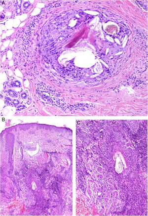 A) Alopecia central centrífuga cicatricial. Presencia de un granuloma a cuerpo extraño frente a fragmentos de un tallo piloso y láminas de queratina (H&E ×100). B y C) Foliculitis decalvante. En estadios avanzados pueden observarse granulomas a cuerpo extraño frente fragmentos de tallos pilosos (B: H&E ×20 y C: H&E ×100).