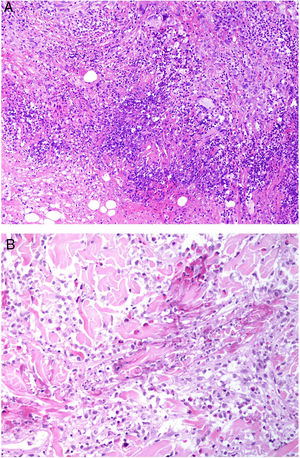 A) Granulomatosis con poliangeitis. Infiltrado granulomatoso con granulomas mal formados constituidos por histiocitos, linfocitos y células gigantes con necrosis supurativa y restos de colágeno necrobiótico (H&E ×100). B) Granulomatosis eosinofílica con poliangeitis. Granuloma constituido por histiocitos dispuestos radialmente alrededor de fibras de colágeno degeneradas con restos de eosinófilos (H&E ×200).