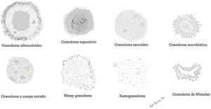 Representación esquemática de los principales tipos de granulomas.