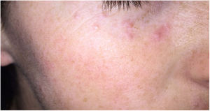 Acné agminata. Pápulas eritematosas periorbitarias.