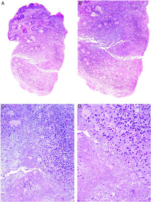 Acné agminata. A) Se observa una respuesta dérmica granulomatosa epitelioide necrosante y caseificante (A: H&E ×20; B: H&E ×40; C: H&E ×100 y D: H&E ×200).