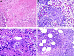 A) Granuloma tuberculoide. Muestra centro de necrosis caseosa rodeado por los histiocitos epitelioides y una evidente célula gigante de tipo Langhans. En periferia se observa una corona linfocitaria (H&E ×100). B) Granuloma sarcoideo. Granuloma epitelioide no necrosante y sin corona linfocitaria prominente («desnudo») (H&E ×100). C) Cuerpo asteroide. Muestra forma de estrella y ubicación intracitoplásmica. Es típico de los granulomas sarcoideos aunque no patognomónico (H&E ×400). D) Granuloma abscesificado (supurado) de una micobacteriosis atípica. Muestra histiocitos epitelioides rodeando un centro de polimorfonucleares neutrófilos (H&E ×100).