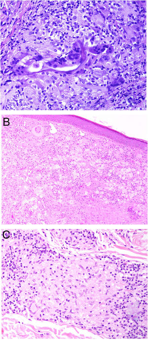 A) Granuloma a cuerpo extraño. Muestra numerosas células gigantes multinucleadas, de núcleos desordenados, abrazando el cuerpo extraño (H&E ×200). B) Xantogranuloma. Abundantes células espumosas junto con alguna ocasional célula de Touton (H&E ×40). C) Granuloma messy de una leishmaniosis. Muestra disposición desordenada de histiocitos de citoplasma claro y muy separados entre sí (H&E ×100).