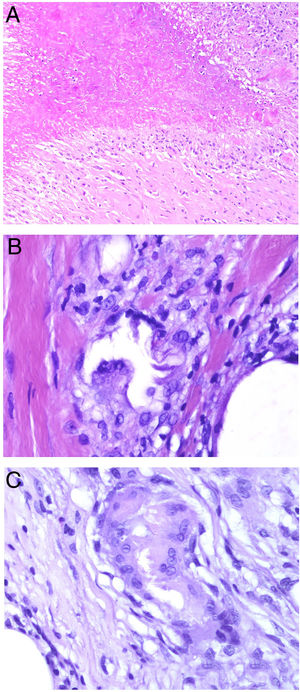 A) Granuloma necrobiótico (en empalizada) correspondiente a un nódulo reumatoide. Muestra material necrobiótico central con los histiocitos dispuestos en empalizada (H&E ×40). B) Granuloma de Miescher correspondiente a un eritema nodoso. Muestra espacio central angulado con histiocitos en periferia (H&E ×400). C) Granuloma de Miescher evolucionado. Con el tiempo, los granulomas de Miescher pueden estar constituidos casi exclusivamente por histiocitos multinucleados (H&E ×400).