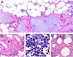 Granulomas a materiales utilizados en dermoestética. A) El material azulado de aspecto mixoide o mucinoso es ácido hialurónico. Está entremezclado con histiocitos conteniendo vacuolas de tamaño variable (flechas) que corresponden a silicona, previamente inyectada (H&E ×200). B) Reacción granulomatosa conteniendo estructuras poligonales de hidrogel de metacrilato acrílico (H&E ×400). C) Reacción al compuesto de ácido hialurónico y dextranos (H&E ×400). D) Esferas de polimetilmetacrilato en colágeno bovino (H&E ×400).
