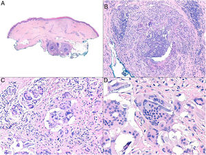 Reacción granulomatosa por material de sutura. A) Panorámica de pieza quirúrgica que muestra 2 granulomas en profundidad (H&E ×40). B) Detalle que muestra un infiltrado inflamatorio mixto, con linfocitos, macrófagos, histiocitos epitelioides y algunas células gigantes multinucleadas a cuerpo extraño, en torno a filamentos de material de sutura (H&E ×200). C) En ocasiones, la célula mayoritaria es la célula gigante multinucleada tipo cuerpo extraño (H&E ×400). D) Células gigante multinucleada digiriendo fibra de material de sutura (H&E ×1.000).