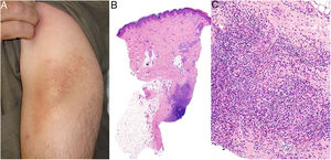 Granuloma por aluminio. A) Nódulo subcutáneo con cambios de liquenificación por rascado en zona de vacunación para desensibilización alérgica. B) El infiltrado ocupa principalmente la hipodermis (H&E ×20). Granulomas constituidos por linfocitos, histiocitos y eosinófilos (H&E ×200).