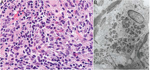 Granuloma por aluminio. A) Histiocitos con citoplasma amplio, violáceo, granuloso (H&E ×400). B) En la microsopía electrónica se demuestra que el granulado citoplásmico corresponde a los depósitos de aluminio.