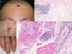 Lesiones ulcerativas en la frente (A) y en el cuero cabelludo (B), junto con hinchazón de los dedos y sangrado periungueal (C). Características histológicas que muestran infiltración linfohistiocitaria focal y necrosis hialina desde la dermis inferior a la hipodermis (D y E). Se observó infiltración linfocítica en las capas musculares (F). Se detectaron células espumosas en los vasos (G).