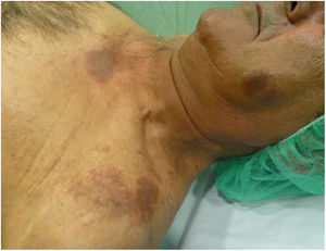 Placas eritematovioláceas a nivel facial y región del escote.