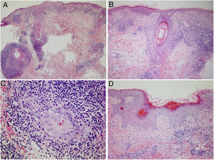 Estudio histopatológico de una de las lesiones. A y B) Denso infiltrado inflamatorio en relación con áreas de epidermis y folículos pilosebáceos. C) Infiltrado compuesto en su mayoría por linfocitos e histiocitos, con escasas células plasmáticas. D) Destacaban zonas con atrofia epidérmica, paraqueratosis y engrosamiento de la membrana basal, alternando con otras en las que la arquitectura se encontraba mejor conservada.