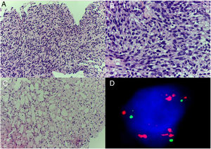 Histología y FISH: la anatomía patológica con hematoxilina-eosina muestra una proliferación neoplásica de células fusiformes (A y B) y áreas focales compatibles con diferenciación grasa (C). El estudio con FISH muestra una amplificación de MDM2 en el brazo largo del cromosoma 12 (D).