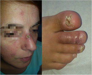 Lesiones de lupus pernio faciales eritematosas con costra en superficie. Dactilitis de 3 dedos del pie derecho asociada a onicopatía.