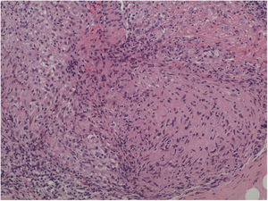 Estudio histológico de lesiones cutáneas faciales con presencia de granulomas en dermis media y profunda, sin necrosis central ni corona linfocitaria.