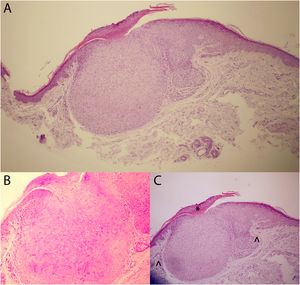 Hallazgos histopatológicos de la lesión extirpada en su totalidad. Destaca la presencia de al menos un infundíbulo hiperplásico con epitelio que remeda al de la vaina radicular externa del folículo piloso, con hipergranulosis y paraqueratosis, constituido por células claras monomorfas, con citoplasma eosinófilo pálido (por la presencia de glucógeno), de núcleo pequeño. A) Visión general. B) Tinción PAS en la que se pone de manifiesto el glucógeno de las células constituyentes de la neoplasia benigna. C) Imagen en detalle con correlación histológica-dermatoscópica de la paraqueratosis (*) y los vasos rodeando la lesión (∧).