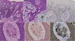 Características histológicas que muestran nidos tumorales basofílicos que se extienden desde la epidermis a la dermis media (hematoxilina y eosina) (a). La mayor ampliación muestra estructuras ductales dentro de los nidos (b), que fueron positivas con la tinción CEA (insert). La tinción MART-1 reveló el incremento del número de melanocitos dentro de los nidos tumorales (c). Una serie de depósitos de melanina dentro de los nidos tumorales, así como melanófagos y materiales amorfos en el estroma (d). Los materiales amorfos en el estroma resultaron positivos con las tinciones Rojo Congo (e) y CK5 (f) (ampliación original a:×40, b: ×200, c: ×100, d-f: ×400).