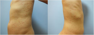 Cúmulos focales de paraqueratosis, exocitosis linfocitaria leve, algunas células inflamatorias mononucleares perivasculares y cierta extravasación eritocitaria (hematoxilina y eosina, ×200).
