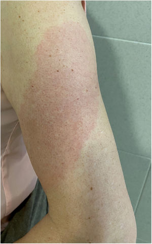 Brazo-COVID (COVID-Arm).