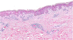 Necrosis salpicada y confluente de queratinocitos con escaso infiltrado inflamatorio perivascular.