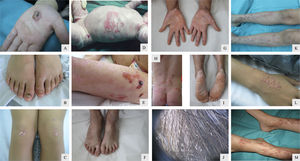 Paciente 1: Niño de 10 años con EASl; 1A) Ampolla en la palma de la mano; 1B) Onicodistrofia; 1C) Cicatrización con quistes de milium en zonas sometidas a traumatismos. Paciente 3: Recién nacida con EASgs; 1D) Ampollas y erosiones cutáneas generalizadas; Control en la infancia; 1E, 1H) Ampollas de distribución herpetiforme en la región lumbar, glútea y muslos junto con signos de cicatrización atrófica; Control en la adolescencia; 1F) Onicodistrofia; 1G, 1I) Queratodermia palmoplantar; 1J) Pseudoliendres o vainas peripilares. Paciente 4: Niña de 7 años con EADp; 1K, 1L, 1M) Papulonódulos pruriginosos localizados en las superficies de extensión de las extremidades.