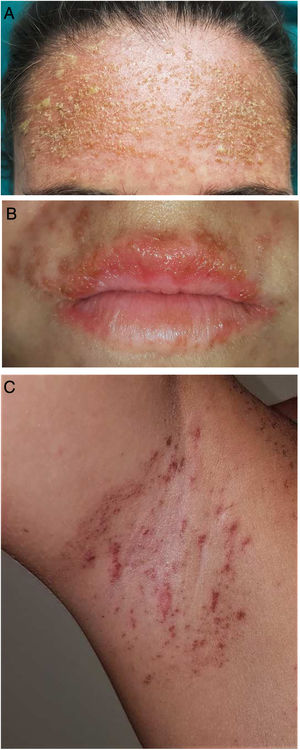 A) Erupción eritematocostrosa con pústulas en la región frontal. B) Múltiples vesículas en el área labial. C) Erupción máculo-papular de aspecto equimótico en el área axilar.