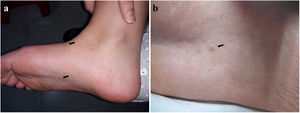 Imágenes clínicas. a. Dos lesiones (←) en el dorso y la planta del pie derecho b. Pápula eritematosa cupuliforme de centro umbilicado (←) en la planta del pie derecho.