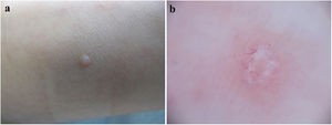 a. Imagen clínica. Pápula cupuliforme del color de la piel normal en el dorso del pie derecho. b. Imagen dermatoscópica. Estructura amarillenta redondeada central y vasos ramificados en corona periféricos.