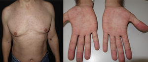 Síndrome antirretroviral agudo con exantema macular eritematoso morbiliforme en tronco a) y afectación palmar b).