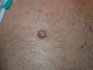 Aspecto macroscópico de la lesión.