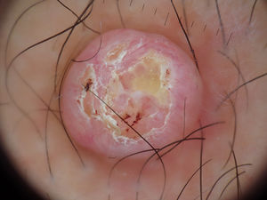 Imagen dermatoscópica de la lesión.