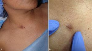 Lesión nodular supraclavicular derecha.