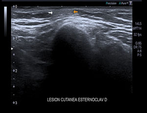Estudio ecográfico con lesión subcutánea hipoecoica bien definida, no encapsulada.