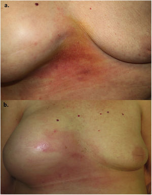 a) Se aprecia una placa eritematosa indurada con leve descamación en zona intermamaria. b) Obsérvese la extensión de la placa eritematosa junto a un considerable aumento del volumen de la mama derecha un mes posterior.