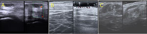 Imágenes ecográficas de malformaciones venosas verrucosas (MVV). A. Ecografía cutánea (22MHz) del caso 1. Epidermis engrosada e hiperecogénica, dermis hipoecogénica, canales vasculares hipoecoicos en la dermis y el tejido celular subcutáneo, sin señal de color Doppler. B. Ecografía cutánea (22MHz) del caso 2. Epidermis engrosada e hiperecogénica con presencia de canales vasculares en la dermis superficial y profunda, sin señal de color Doppler. C. Ecografía cutánea (22MHz) que muestra una epidermis hiperecogénica, una disminución de la ecogenicidad de la dermis y una pérdida de la definición dermohipodérmica. El tejido celular subcutáneo se observa engrosado y heteroecoico, en ausencia de señal de color Doppler.