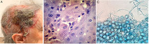 A. Imagen clínica. Se evidencia placa eritematocostrosa que ocupa la totalidad del cuero cabelludo, con costra amarillenta, por sectores melicérica, exudado seropurulento y áreas de alopecia cicatrizal. B. Biopsia cutánea de lesiones. Hematoxilina-eosina. En dermis profunda se evidencian elementos levaduriformes intracelulares, rodeados de un halo periférico. C. Examen directo de colonias de H. capsulatum aisladas en agar Sabouraud. Se visualizan macroconidios verrucosos característicos.