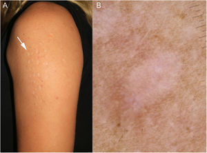 A) Máculas en el brazo de la paciente. B) Imagen dermatoscópica.